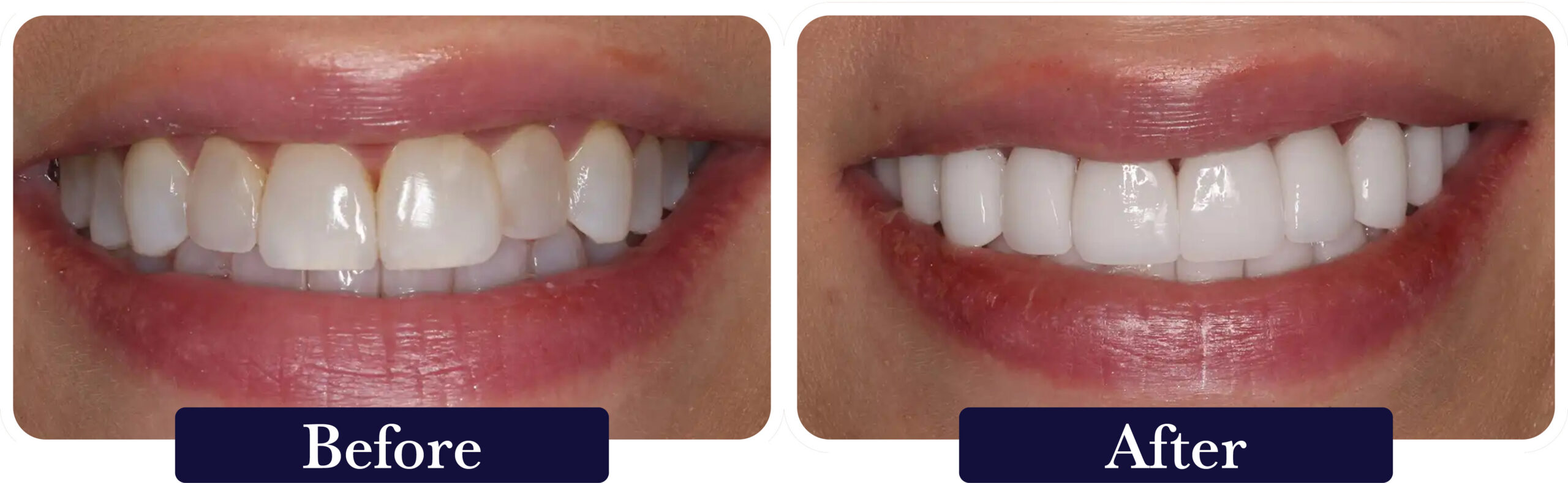 huckabee-smile-gallery-before-after-veneers3 A close up of a patient's smile before and after dental veneers at Huckabee Dental in Southlake, TX.