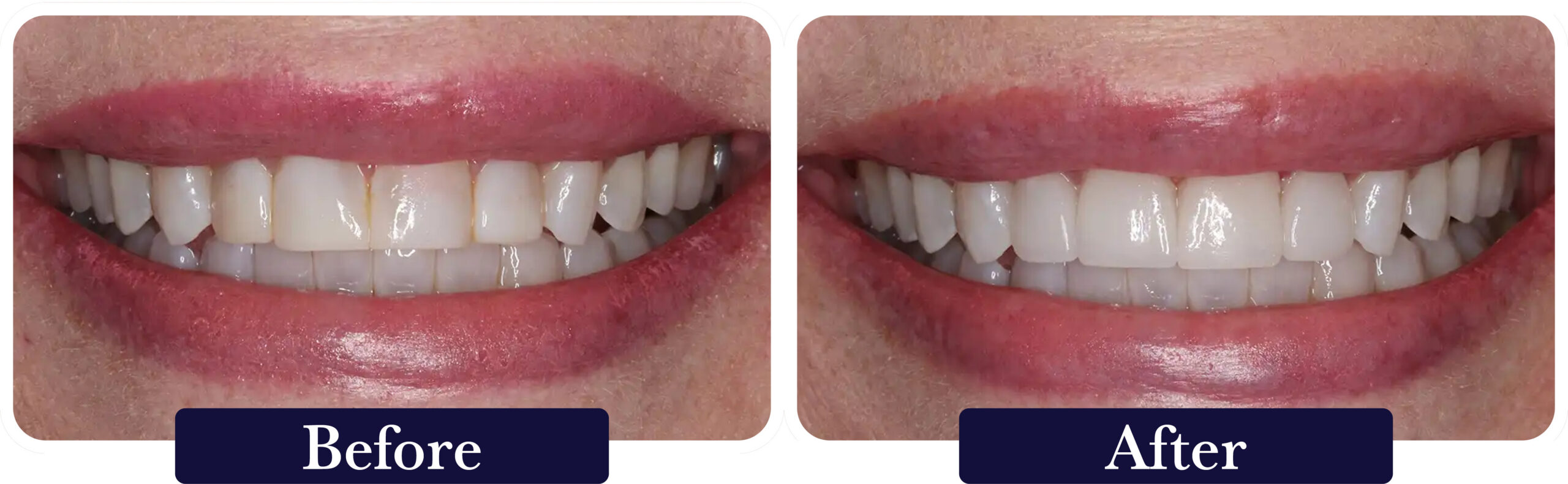 huckabee-smile-gallery-before-after-veneers4 A close up of a patient's smile before and after dental veneers at Huckabee Dental in Southlake, TX.